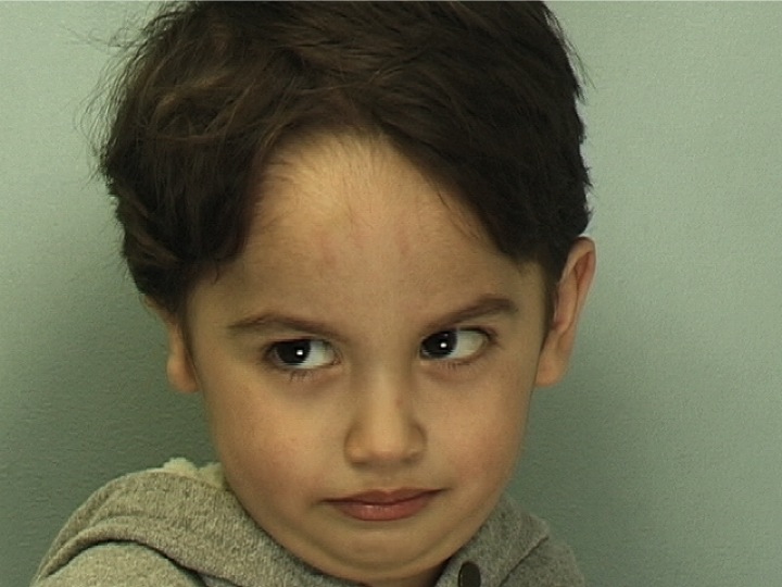 Patient 1 - Before Surgery