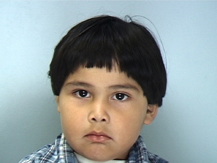 Patient 2 - Before Surgery