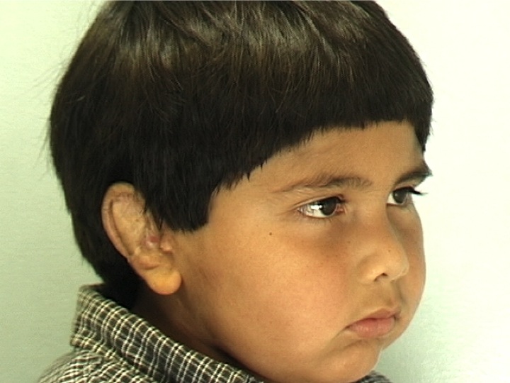 Patient 2 - After Surgery